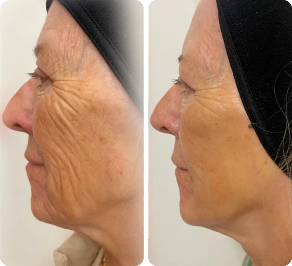 Side profile before and after two low-energy NeoGen treatments