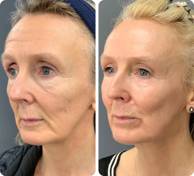 Three-quarter view before and four months after two high-energy NeoGen treatments